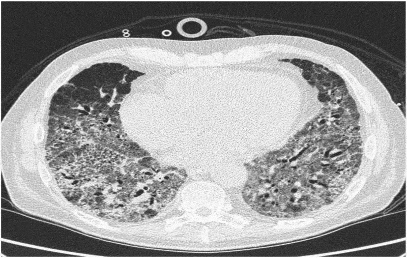 Remarkable benefits of intravenous immunoglobulin (IVIG) in a patient with polymyositis-associated acute interstitial lung disease.