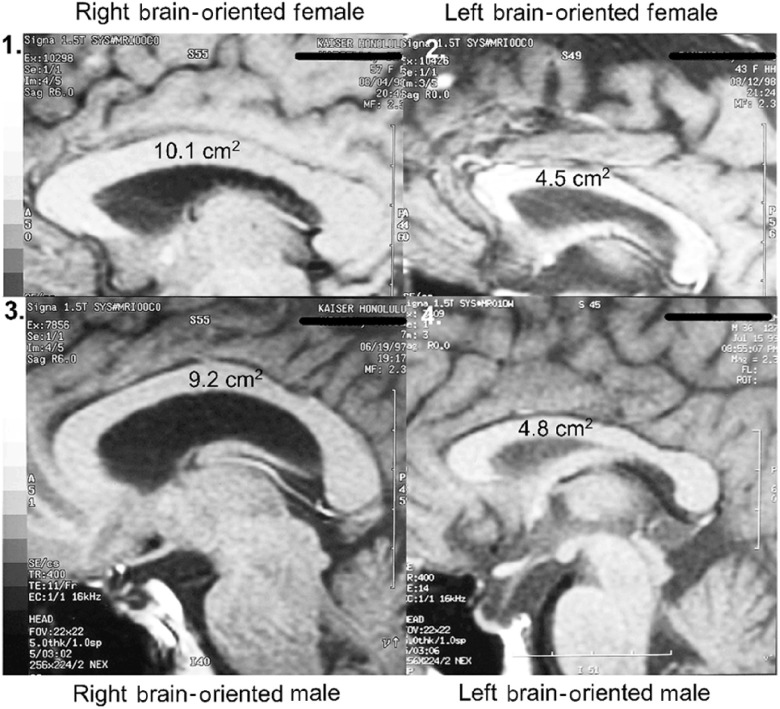 Brain executive laterality and hemisity.