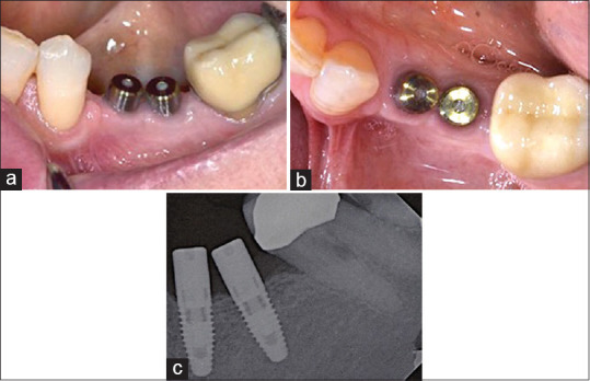 Restoration of converging implants: Restorative complexity to facilitate retrievability.