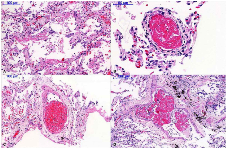 Severe Acute Respiratory Distress Syndrome Secondary to Coronavirus 2 (SARS-CoV-2).