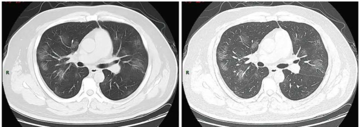 Severe Acute Respiratory Distress Syndrome Secondary to Coronavirus 2 (SARS-CoV-2).