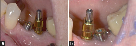 Restoration of converging implants: Restorative complexity to facilitate retrievability.