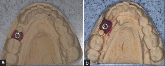 Restoration of converging implants: Restorative complexity to facilitate retrievability.
