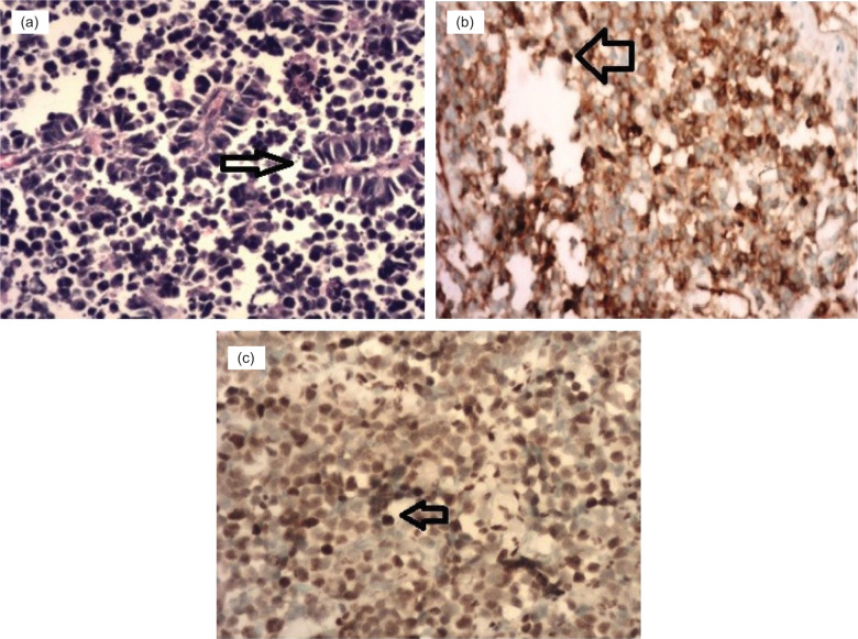 Do Primitive Neuroectodermal Tumors of the Kidney Have a Predilection for Inferior Vena Cava Involvement? A Case Series and Review of the Literature.