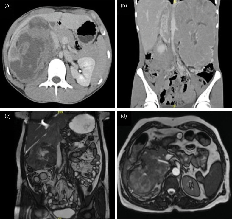 Do Primitive Neuroectodermal Tumors of the Kidney Have a Predilection for Inferior Vena Cava Involvement? A Case Series and Review of the Literature.