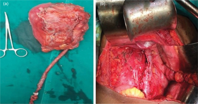 Do Primitive Neuroectodermal Tumors of the Kidney Have a Predilection for Inferior Vena Cava Involvement? A Case Series and Review of the Literature.