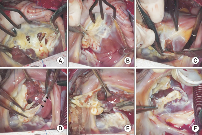 Cone Repair in Adult Patients with Ebstein Anomaly.