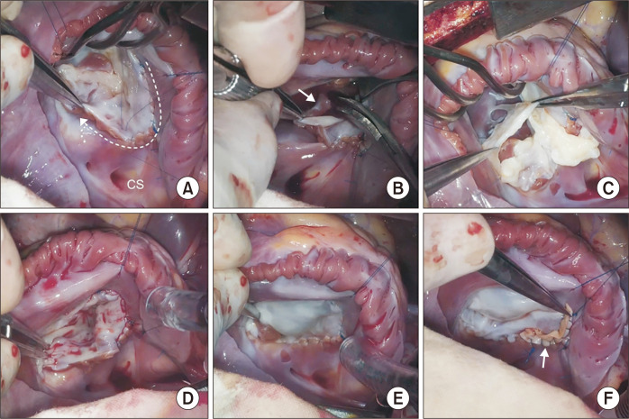 Cone Repair in Adult Patients with Ebstein Anomaly.