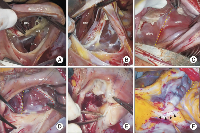 Cone Repair in Adult Patients with Ebstein Anomaly.