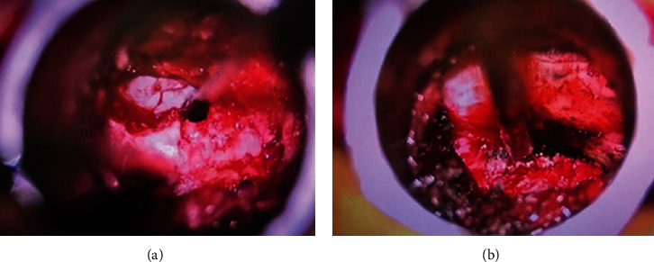 Direct Pars Defect Tubular Decompression and TLIF for the Treatment of Low-Grade Adult Isthmic Spondylolisthesis: Surgical Challenges and Nuances of a Muscle-Sparing Minimally Invasive Approach.