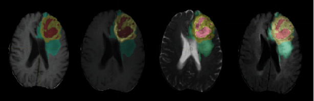 Machine Learning Based on a Multiparametric and Multiregional Radiomics Signature Predicts Radiotherapeutic Response in Patients with Glioblastoma.