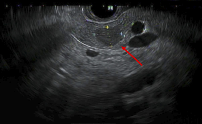 Robotic Distal Pancreatectomy and Splenectomy for an Intrapancreatic Hepatocellular Carcinoma: A Case Report and Review of the Literature.