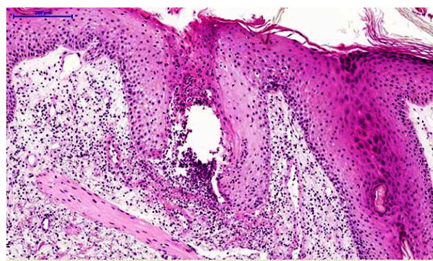 Aseptic Folliculitis in Freshwater and Marine Fishermen.