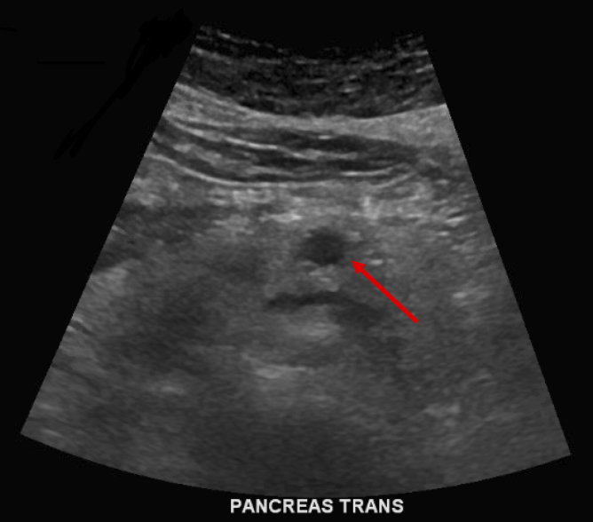 Robotic Distal Pancreatectomy and Splenectomy for an Intrapancreatic Hepatocellular Carcinoma: A Case Report and Review of the Literature.