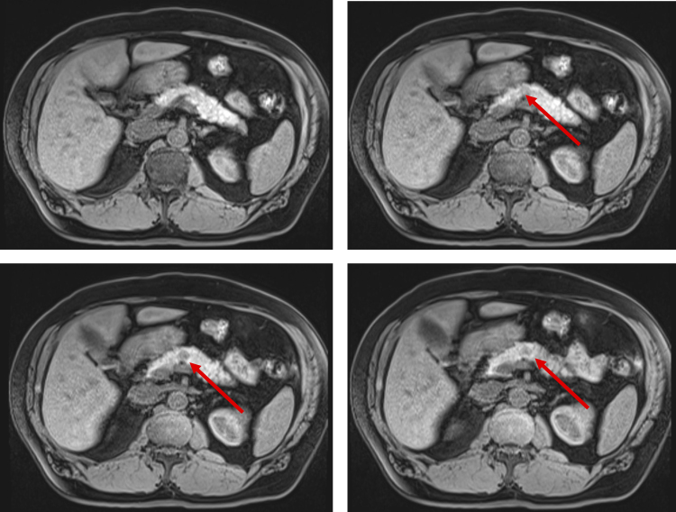 Robotic Distal Pancreatectomy and Splenectomy for an Intrapancreatic Hepatocellular Carcinoma: A Case Report and Review of the Literature.