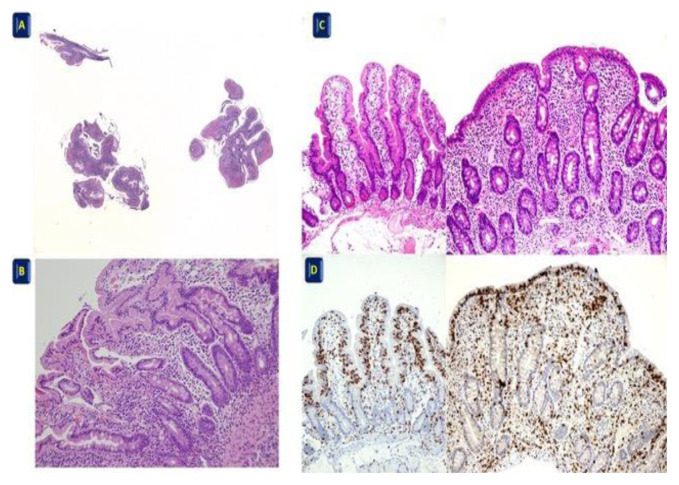 Histopathology of Celiac Disease. Position Statements of the Italian Group of Gastrointestinal Pathologists (GIPAD-SIAPEC).