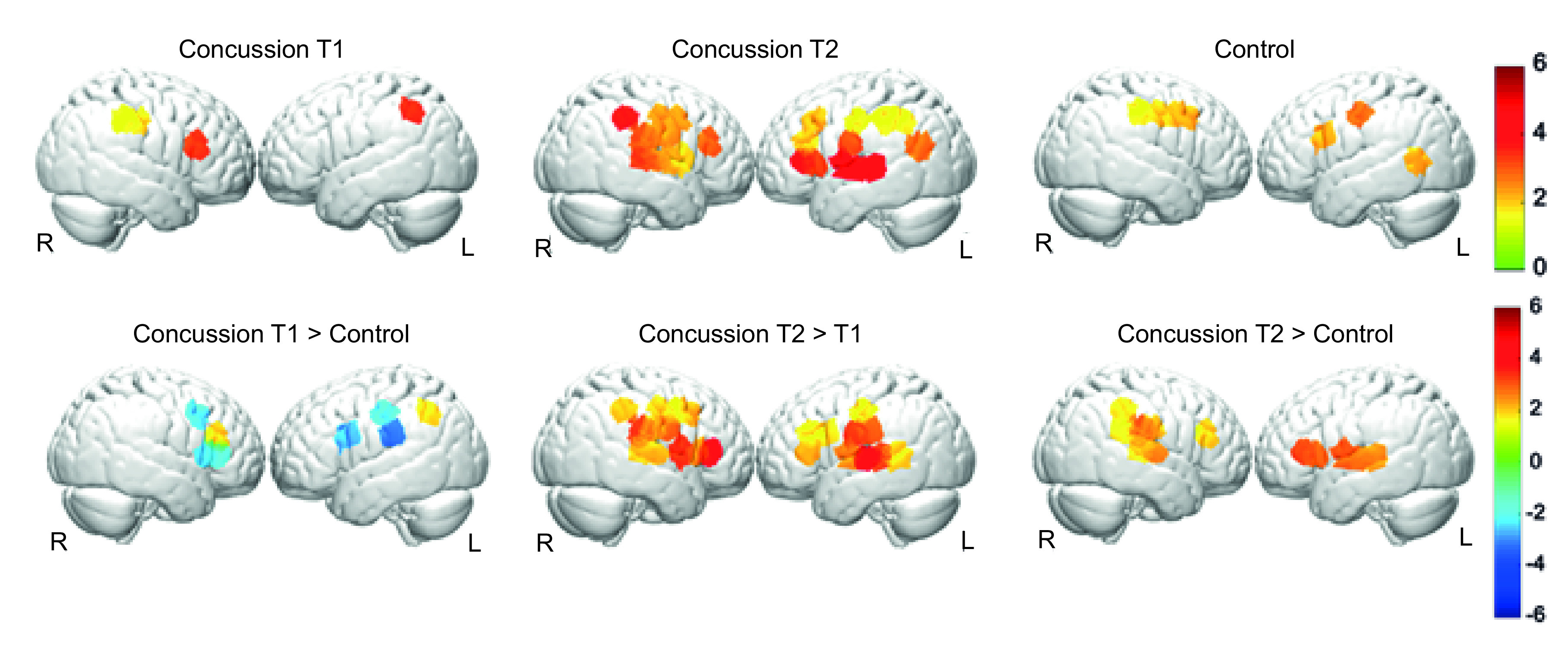 Persistent alterations of cortical hemodynamic response in asymptomatic concussed patients.