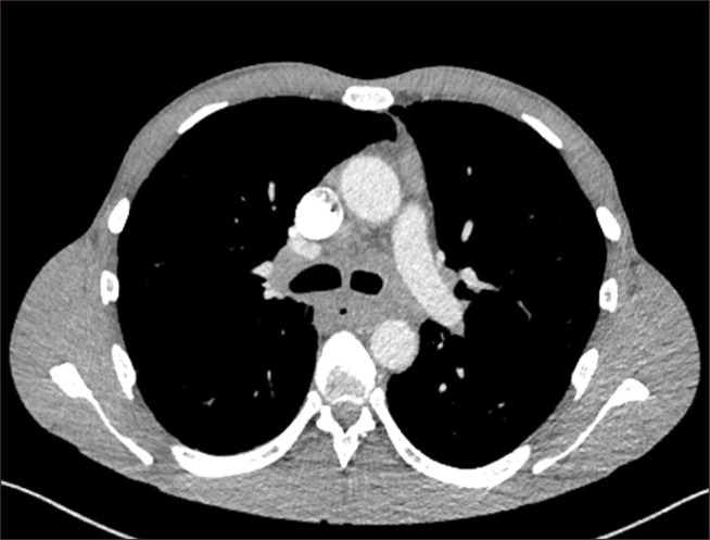 Minimally Invasive Approach to Esophageal Perforation after Endoscopic Ultrasound-Guided Fine-Needle Aspiration: A Report of 2 Cases.