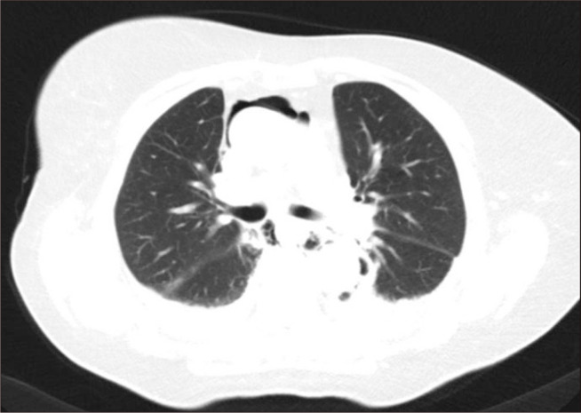 Minimally Invasive Approach to Esophageal Perforation after Endoscopic Ultrasound-Guided Fine-Needle Aspiration: A Report of 2 Cases.