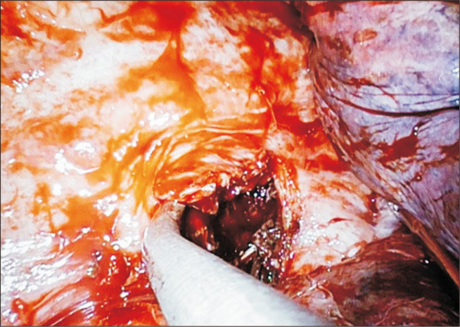 Minimally Invasive Approach to Esophageal Perforation after Endoscopic Ultrasound-Guided Fine-Needle Aspiration: A Report of 2 Cases.