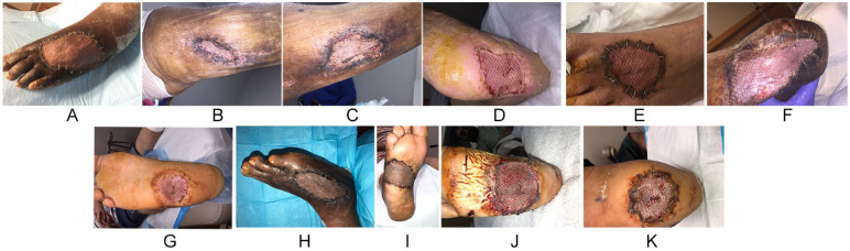 Split Thickness Skin Graft of the Foot and Ankle Bolstered With Negative Pressure Wound Therapy in a Diabetic Population: The Results of a Retrospective Review and Review of the Literature.