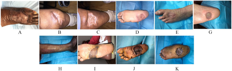 Split Thickness Skin Graft of the Foot and Ankle Bolstered With Negative Pressure Wound Therapy in a Diabetic Population: The Results of a Retrospective Review and Review of the Literature.