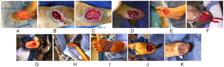 Split Thickness Skin Graft of the Foot and Ankle Bolstered With Negative Pressure Wound Therapy in a Diabetic Population: The Results of a Retrospective Review and Review of the Literature.