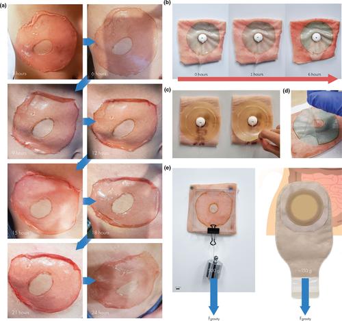 Biocompatible hydrogel ostomy adhesive