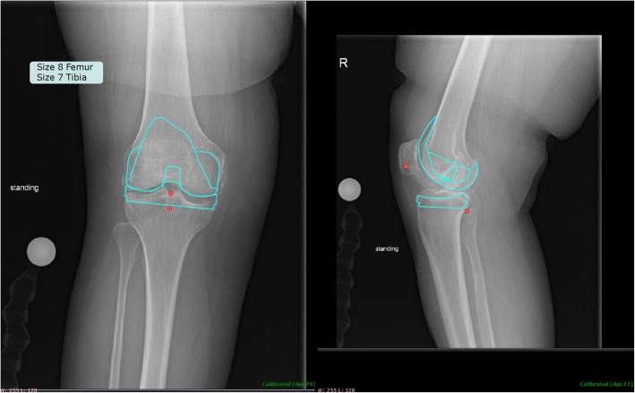 Demographic data is more predictive of component size than digital radiographic templating in total knee arthroplasty.