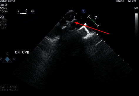 Aortic Cannulation around Grade 5 Aortic Arch Atheroma Utilizing Transesophageal Echocardiography.