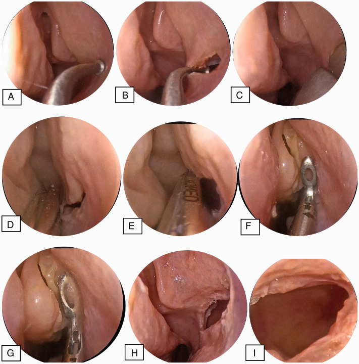 Seeker Uncinectomy: A Randomized Controlled Cadaveric Trial.