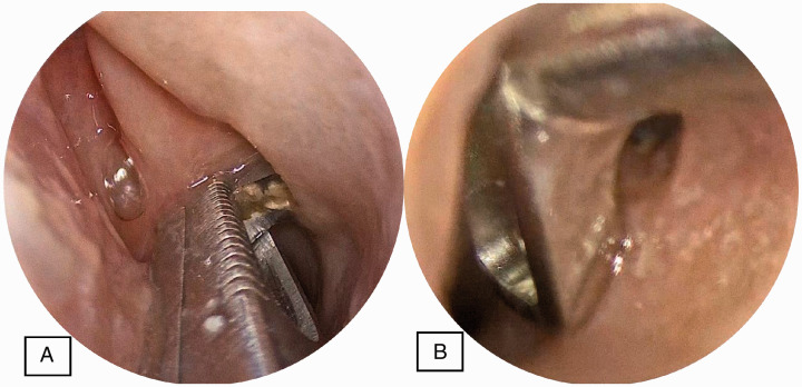 Seeker Uncinectomy: A Randomized Controlled Cadaveric Trial.