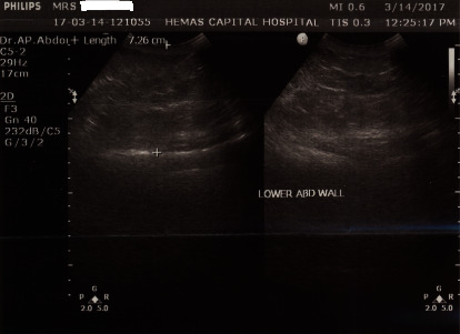 Pulmonary Hypertension and Hypocholesterolemia Secondary to Thyrotoxicosis.