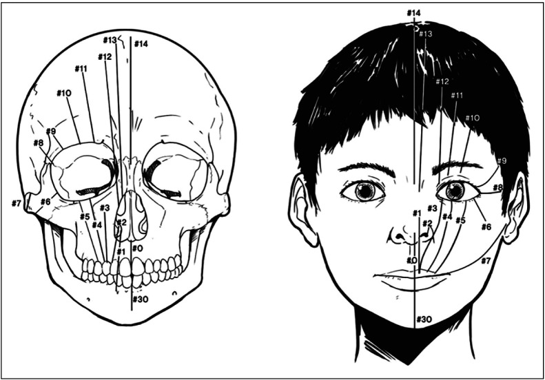 Distribution, side involvement, phenotype and associated anomalies of Korean patients with craniofacial clefts from single university hospitalbased data obtained during 1998-2018.