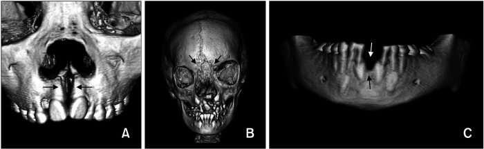 Distribution, side involvement, phenotype and associated anomalies of Korean patients with craniofacial clefts from single university hospitalbased data obtained during 1998-2018.