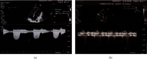 Pulmonary Hypertension and Hypocholesterolemia Secondary to Thyrotoxicosis.