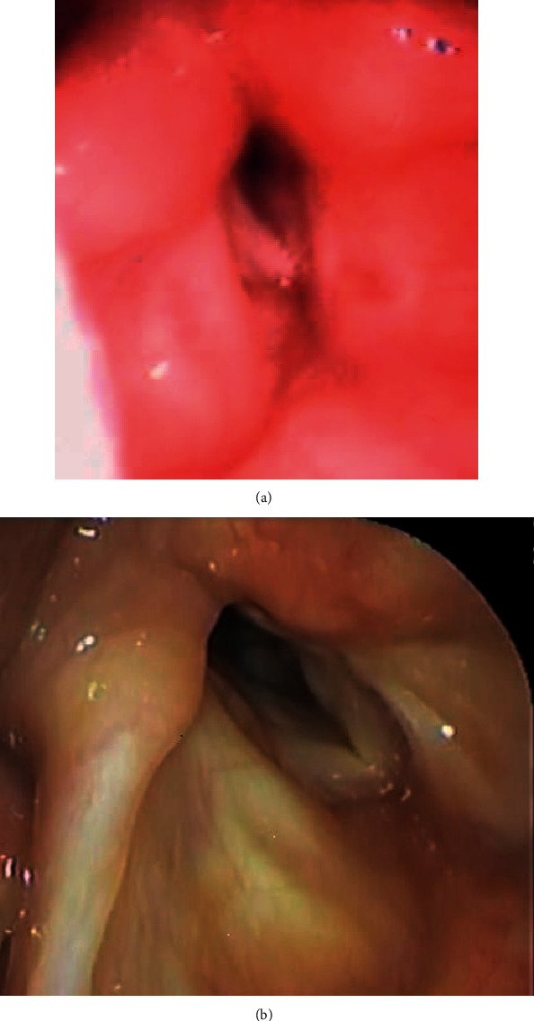 Efficacy of Arytenoidectomy after Suture Lateralisation Failure in Patients with Bilateral Vocal Cord Paralysis.