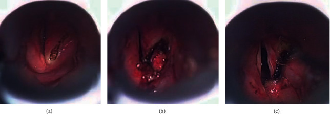 Efficacy of Arytenoidectomy after Suture Lateralisation Failure in Patients with Bilateral Vocal Cord Paralysis.