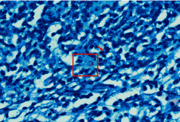 Adverse Events of the BCG (Bacillus Calmette-Guérin) and Rotavirus Vaccines in a Young Infant with Inborn Error of Immunity.