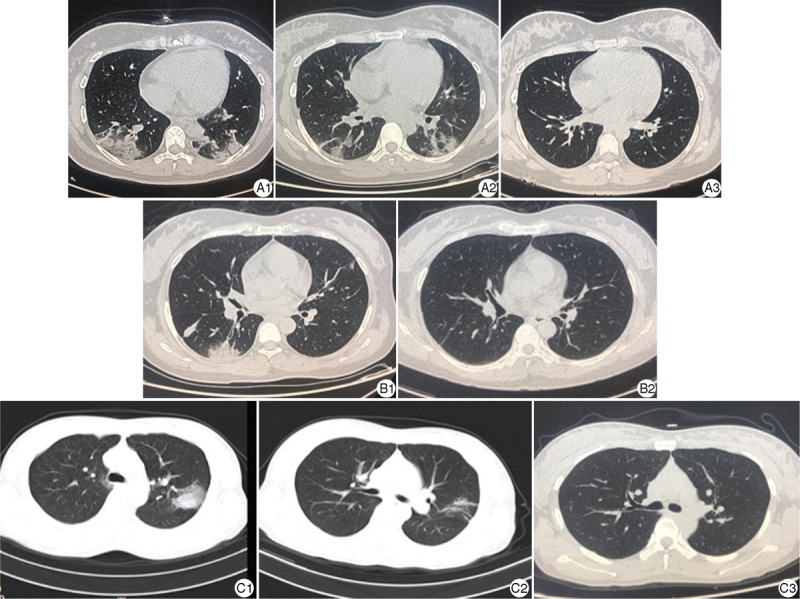 Follow-up Study on the Outcomes of Recovered Pregnant Women with a History of COVID-19 in the First and Second Trimesters: A Case Series from China.