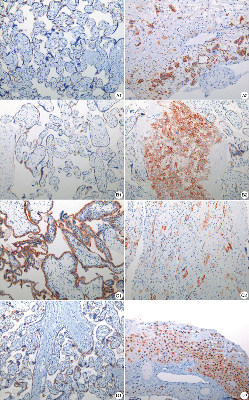 Follow-up Study on the Outcomes of Recovered Pregnant Women with a History of COVID-19 in the First and Second Trimesters: A Case Series from China.