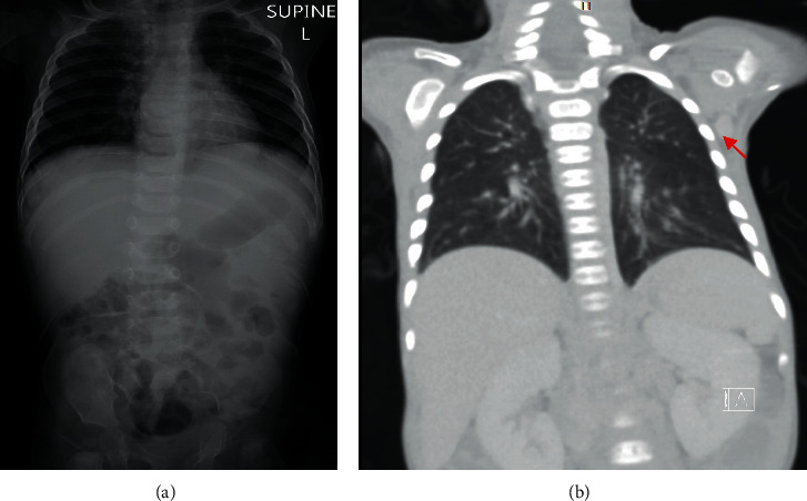 Adverse Events of the BCG (Bacillus Calmette-Guérin) and Rotavirus Vaccines in a Young Infant with Inborn Error of Immunity.