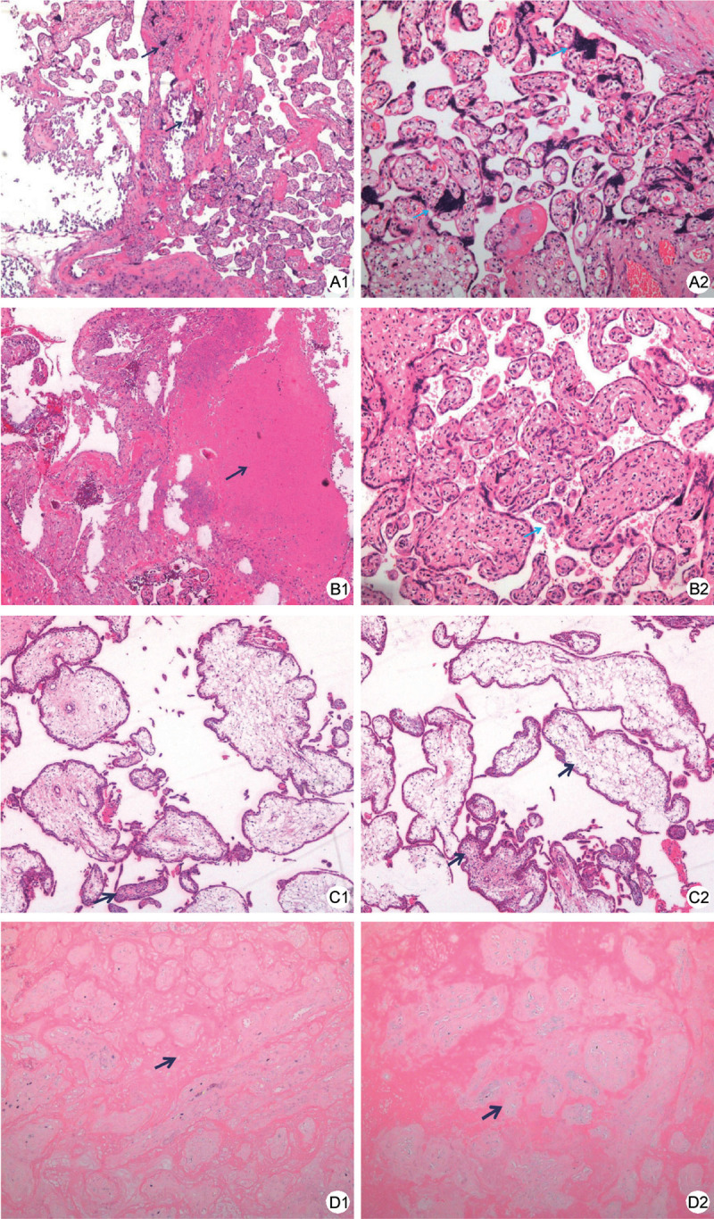 Follow-up Study on the Outcomes of Recovered Pregnant Women with a History of COVID-19 in the First and Second Trimesters: A Case Series from China.