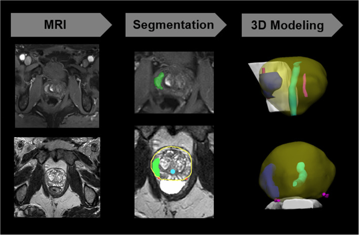 MRI guided procedure planning and 3D simulation for partial gland cryoablation of the prostate: a pilot study.