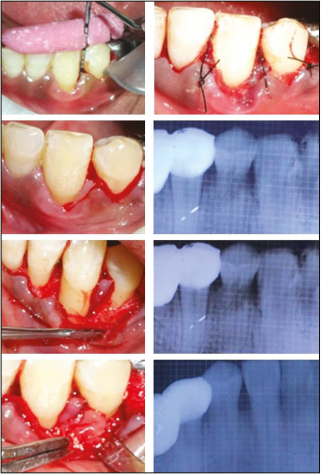 Comparison of Regenerative Potential of Platelet-rich Fibrin Alone and in Combination with Bovine Bone Graft in Intraosseous Defect by Single Flap Approach: A Clinical and Radiographic Study.