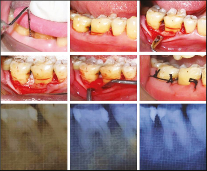 Comparison of Regenerative Potential of Platelet-rich Fibrin Alone and in Combination with Bovine Bone Graft in Intraosseous Defect by Single Flap Approach: A Clinical and Radiographic Study.
