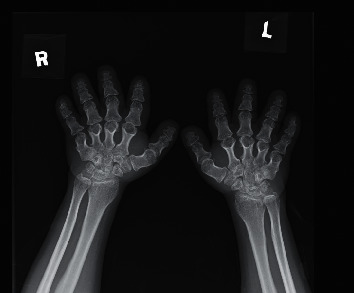 Headache in a Child with Pseudohypoparathyroidism: An Alarming Symptom Not to Miss.