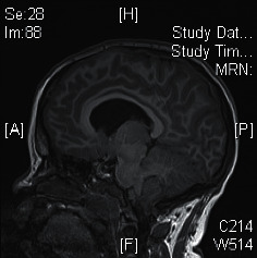 Headache in a Child with Pseudohypoparathyroidism: An Alarming Symptom Not to Miss.