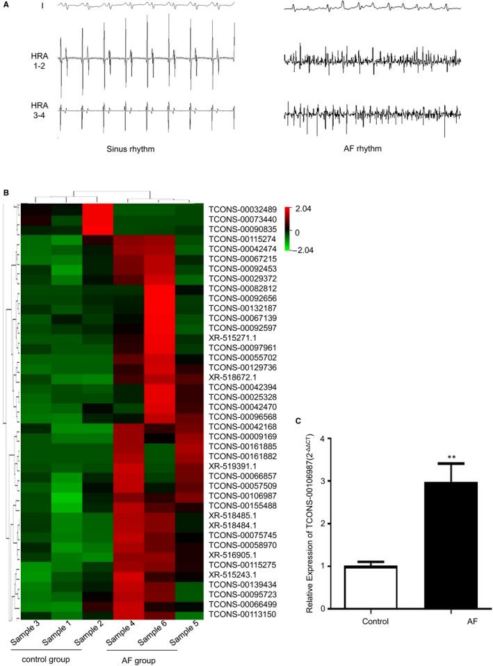 Long noncoding RNA TCONS-00106987 promotes atrial electrical remodelling during atrial fibrillation by sponging miR-26 to regulate KCNJ2.