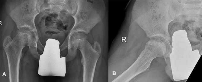 Role of Arthrodiastasis Using Hinged Monolateral External Fixator Without Soft Tissue Release in Advanced Stage of Legg-Calve-Perthes Disease.